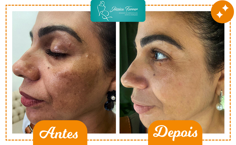 Dermaplaning + Limpeza de Pele + LED + Hidratação